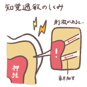 知覚過敏が起きる仕組みのイラスト
