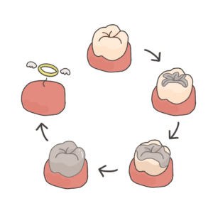 むし歯を繰り返して歯を失ってしまう経緯を現したイラスト