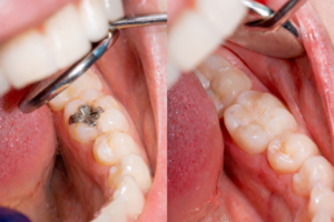 奥歯に銀歯を詰めた口と、白い歯の口の比較写真
