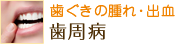 歯ぐきの腫れ・出血