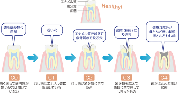 むし歯の進行